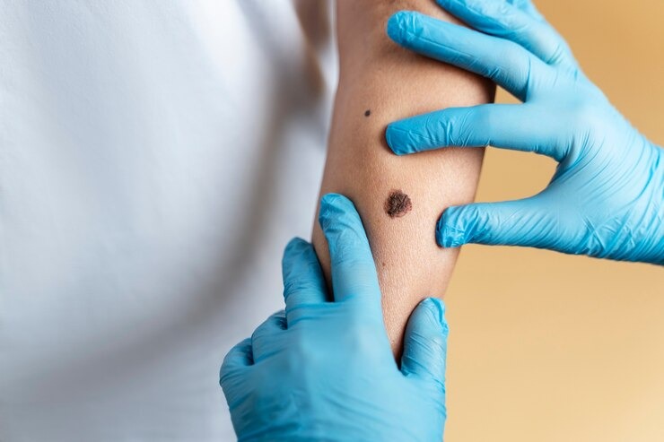 Informa IMSS Veracruz Sur sobre como identificar melanoma, por exposición prologada al sol