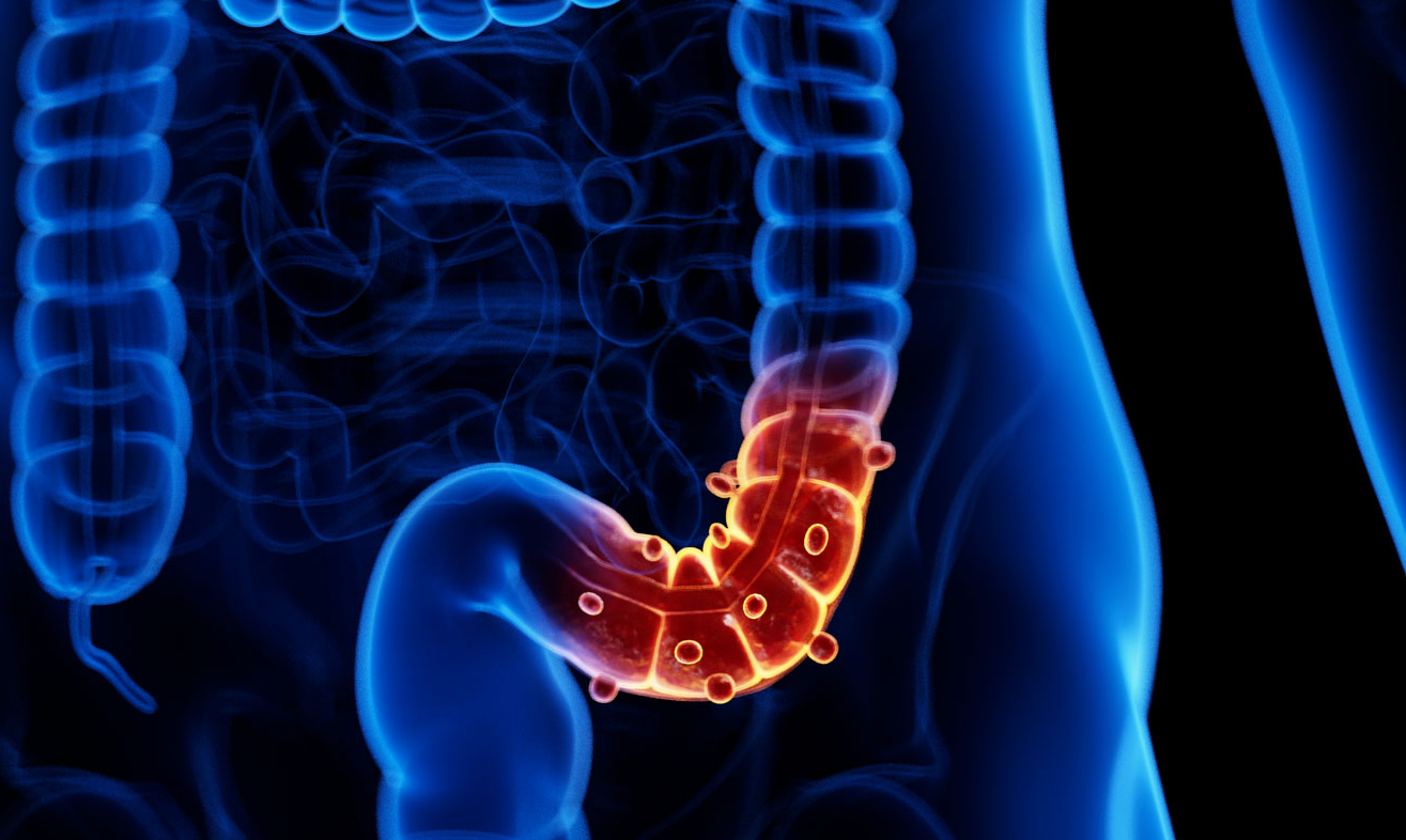 Advierte IMSS Veracruz Norte sobre diverticulitis