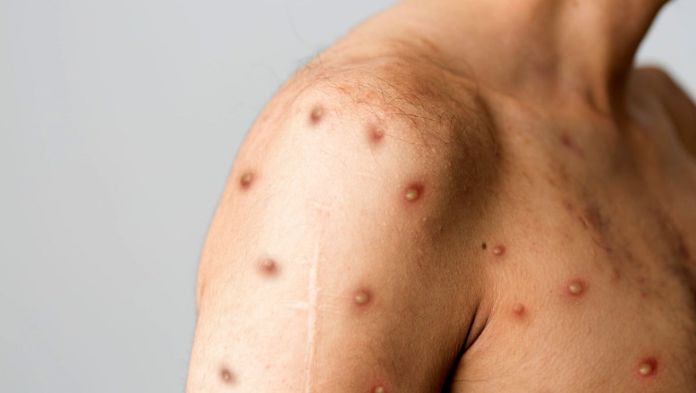 Paciente con viruela del mono que se reportó en Veracruz ya sanó: Sesver