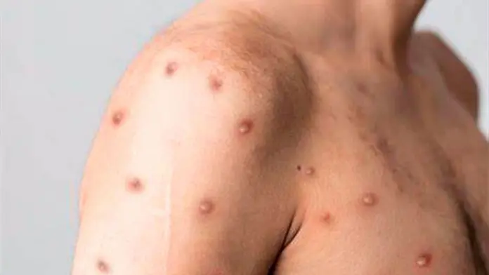 Secretaría de Salud federal emite aviso epidemiológico por mpox