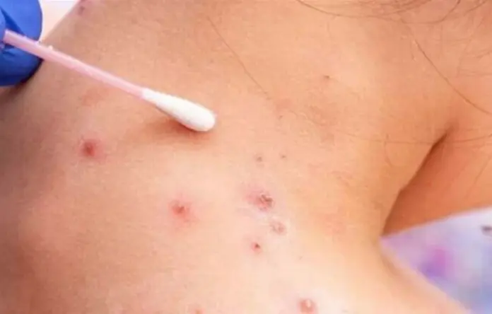 Veracruz suma dos casos de viruela símica