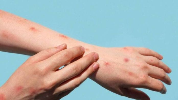 Veracruz confirma 4 casos de mpox y 15 probables