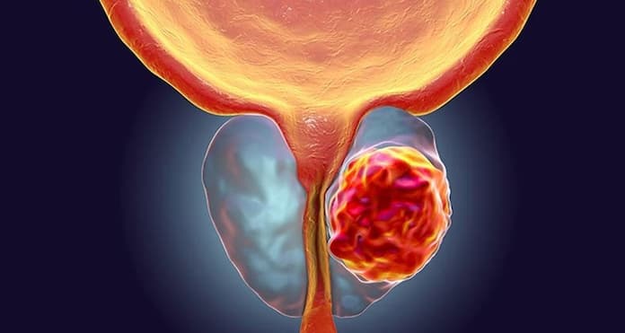 Invita IMSS Veracruz Norte a hombres mayores de 40 años a prevenir cáncer de próstata