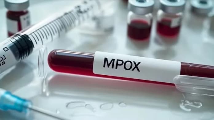 Investigan en Veracruz 24 casos probables de mpox
