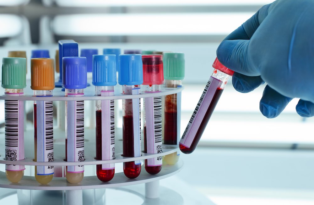 Informa IMSS Veracruz Norte sobre trastorno en tiempos de coagulación de la sangre