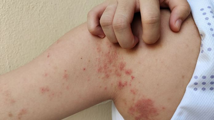 UNAM advierte que la lepra, un problema de salud que persiste en México