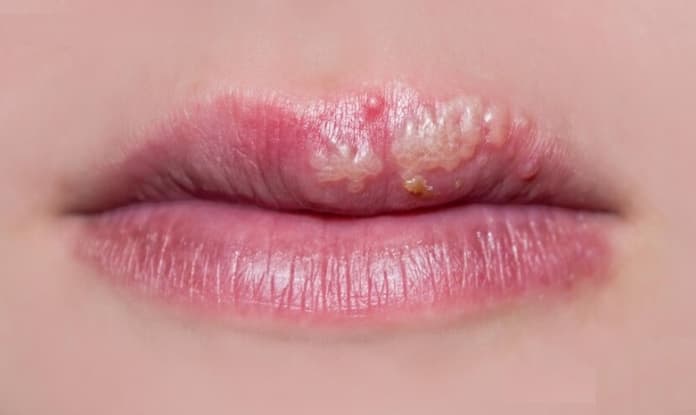 Advierte IMSS Veracruz Norte sobre herpes labial