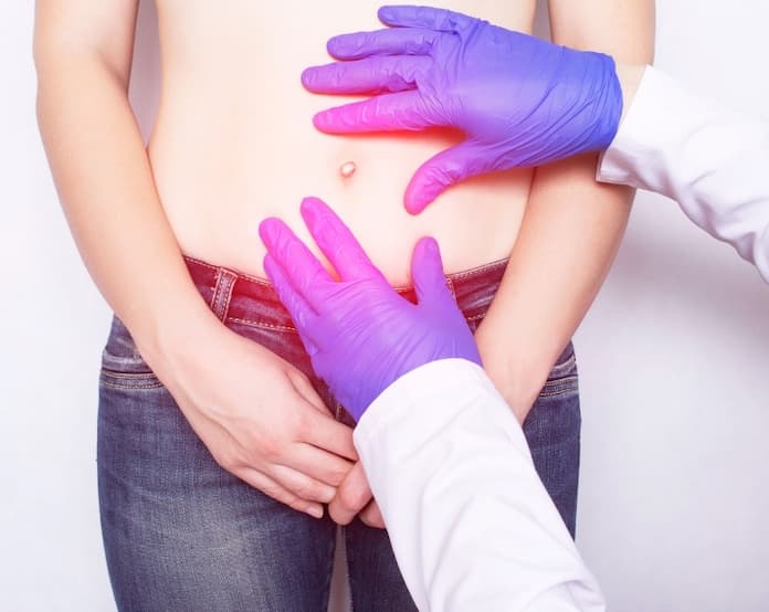 Recomienda IMSS Veracruz Norte atender hernias abdominales de manera oportuna