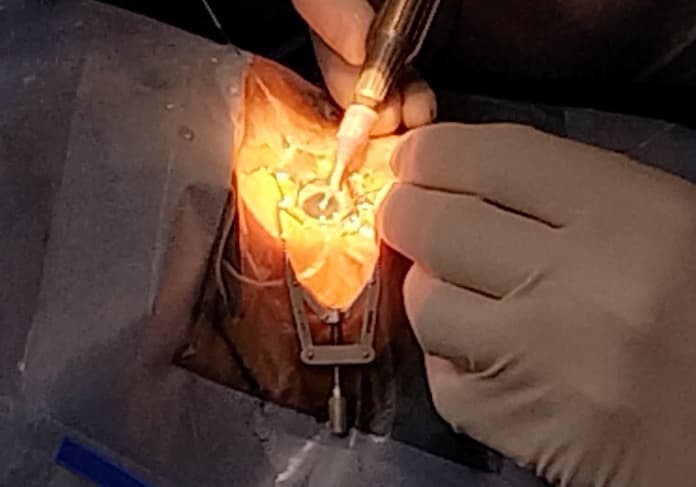 Llevará IMSS Veracruz Norte a cabo una doble Jornada Quirúrgica de Cataratas en HGZ No. 11 de Xalapa