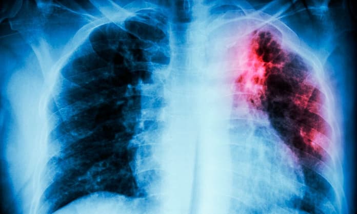 Tuberculosis supera los 7 mil casos en México