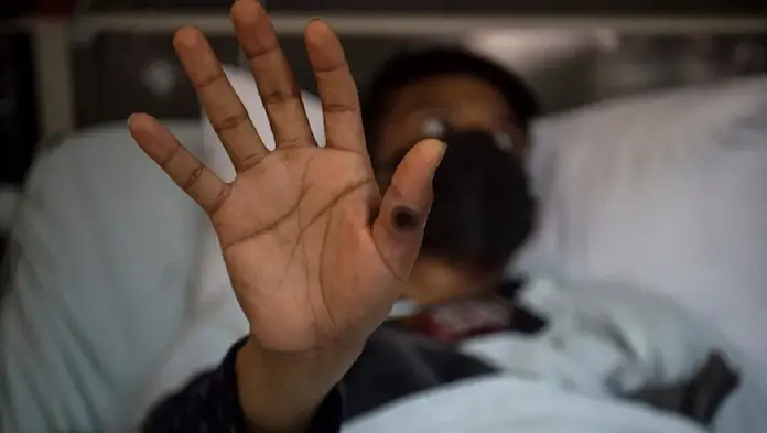 OMS levanta emergencia sanitaria por Mpox ante descenso de casos registrados