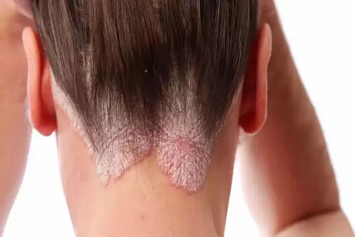 Informa IMSS Veracruz Norte importancia de reconocer y tratar oportunamente psoriasis