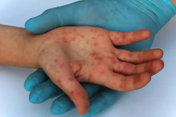 México rebasa los cinco mil casos de sarampión