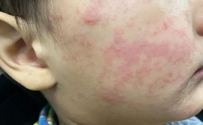 Suman 32 muertes por sarampión