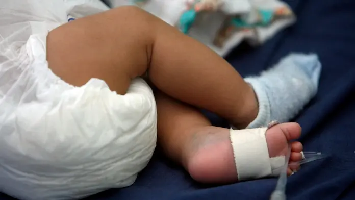 Guerrero informa su primera mu€rte por sarampión; víct1ma es un bebé