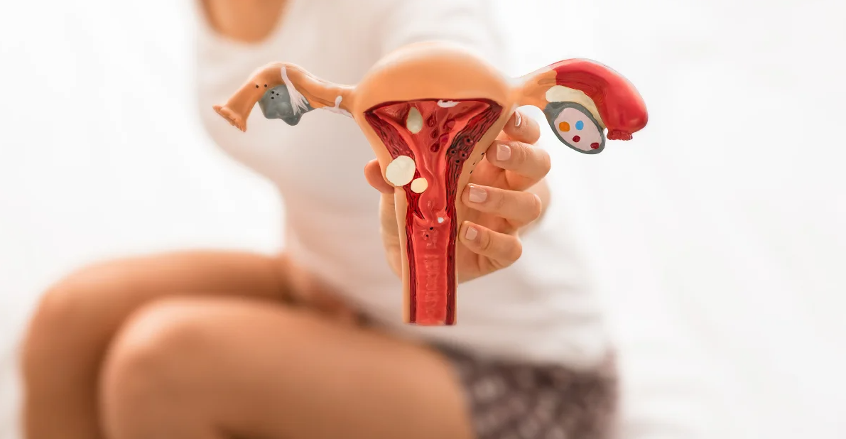 Invita IMSS Veracruz Norte a detectar oportunamente endometriosis