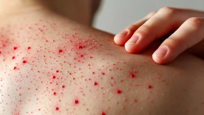 Veracruz cierra enero con 6 casos confirmados y 88 casos probables acumulados de sarampión