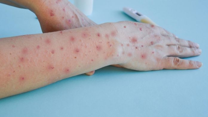 Viruela símica experimenta repunte en México; CDMX concentra el 66% de todos los casos