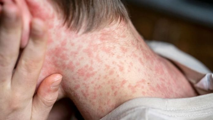 PAN responsabiliza a Morena por el brote de sarampión