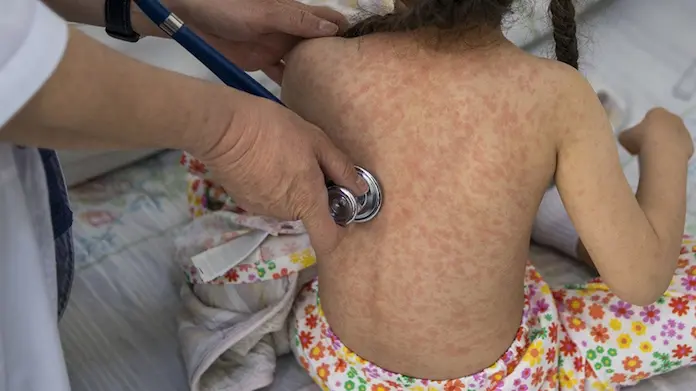 Reportan nueva muerte por sarampión en México