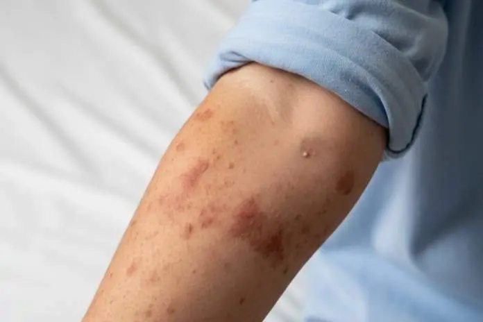 Casos de sarampión en México durante 2026 ya superan el total del año pasado