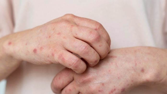 Veracruz suma 51 casos de sarampión en brote nacional